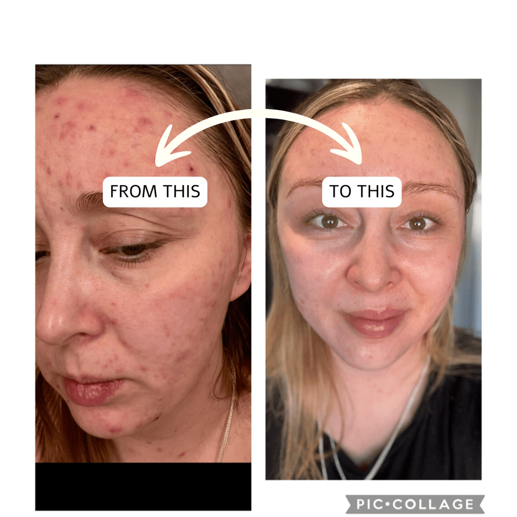 ADULT/HORMONAL BREAKOUTS - Bee Haven Bodycare & Gifts