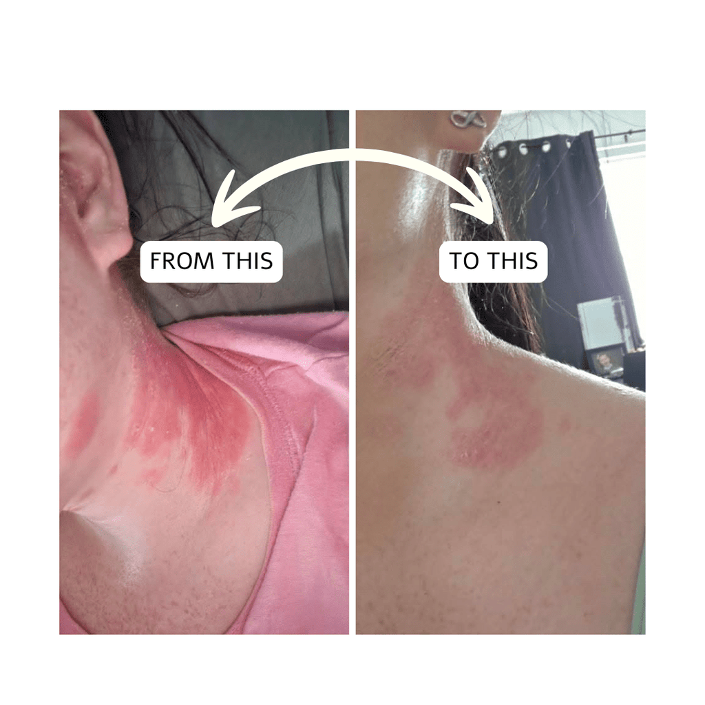 Eczema, Psoriasis, Dry Itchy Skin - Bee Haven Bodycare & Gifts