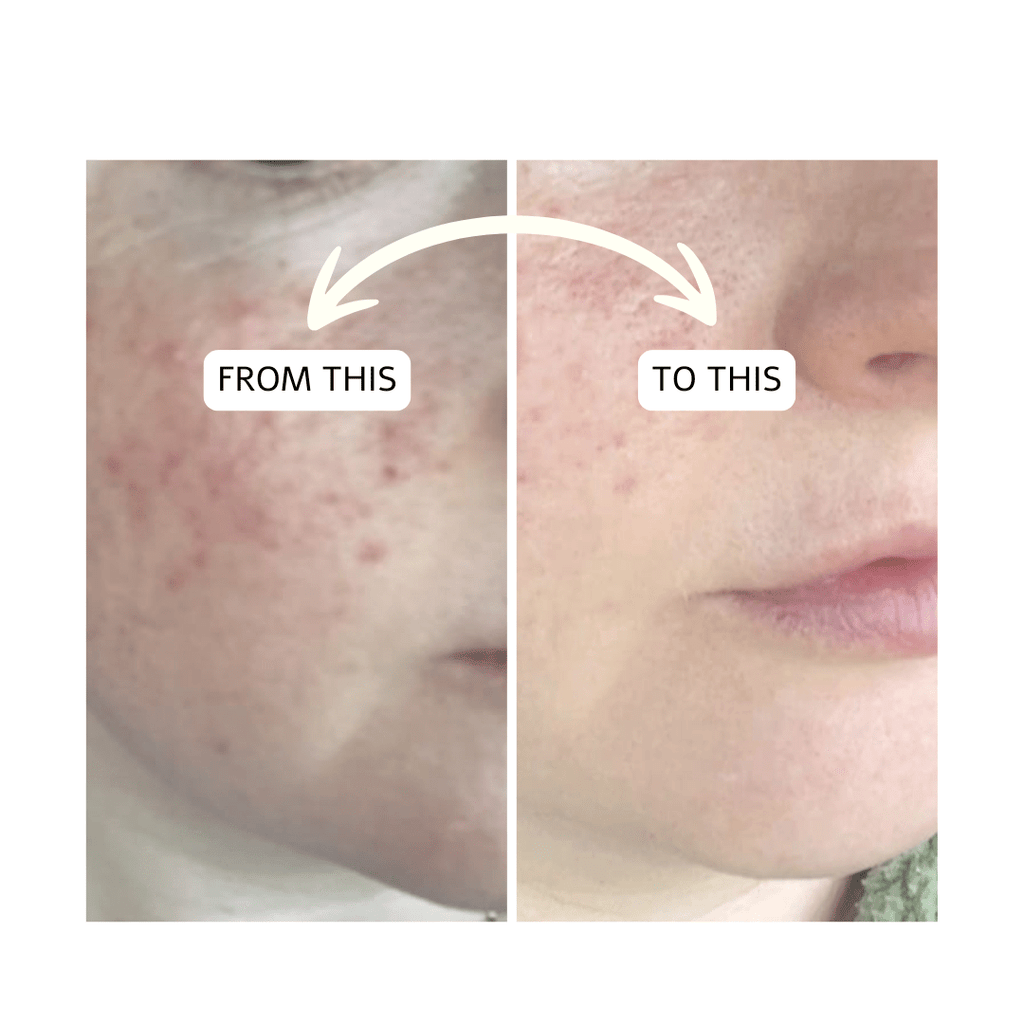 Rosacea Skin Care Routine - Bee Haven Bodycare & Gifts