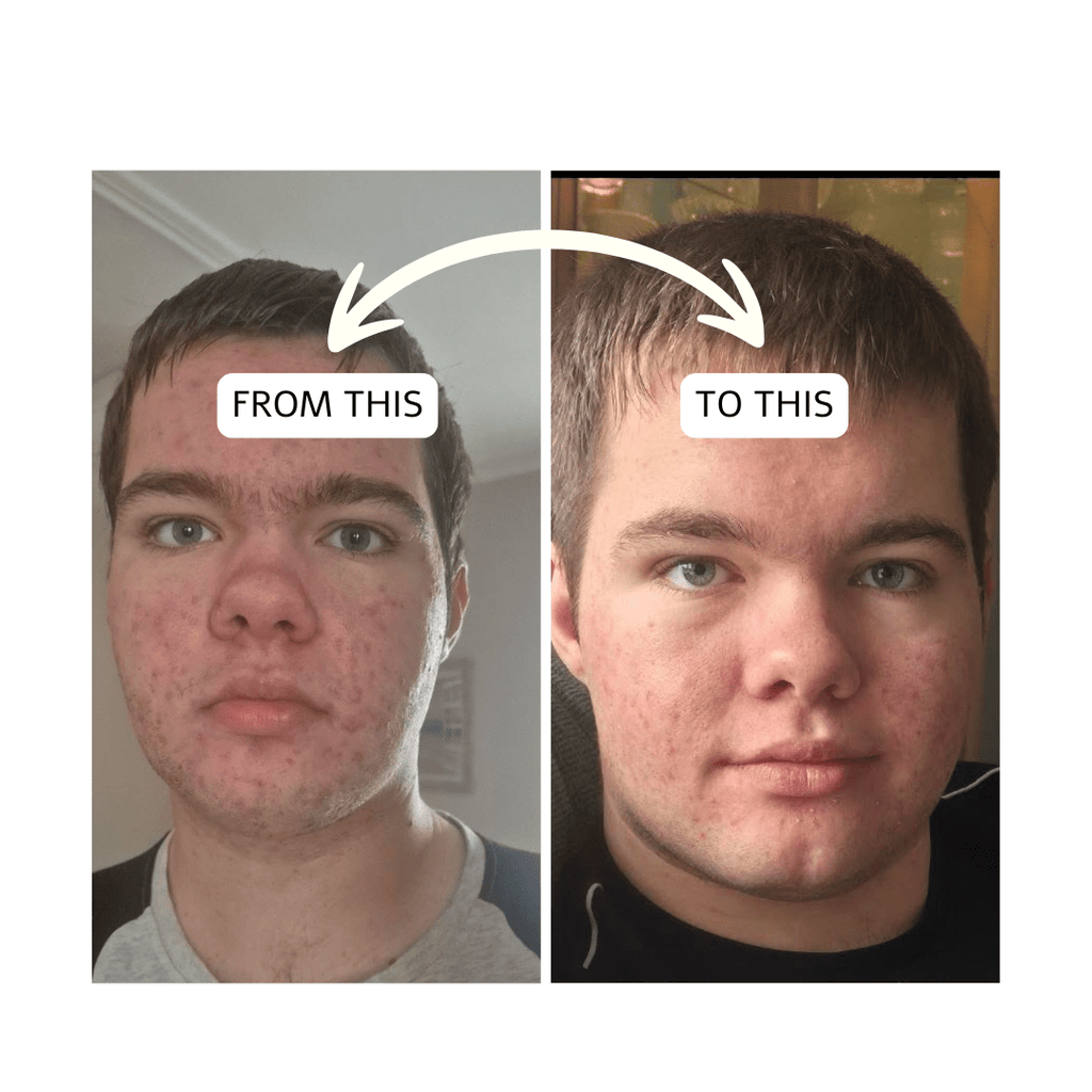 Teen Skin Breakouts - Bee Haven Bodycare & Gifts